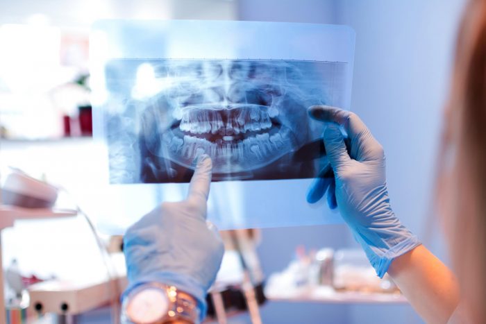 X ray of teeth