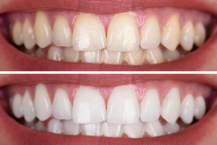 teeth before and after